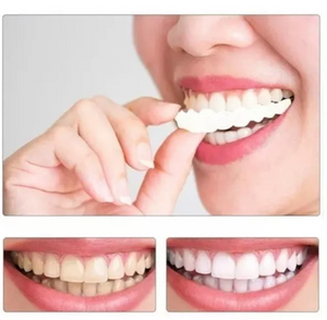 SONRISA IMPECABLE CON UNA CARILLA DENTAL DE ASPECTO NATURAL