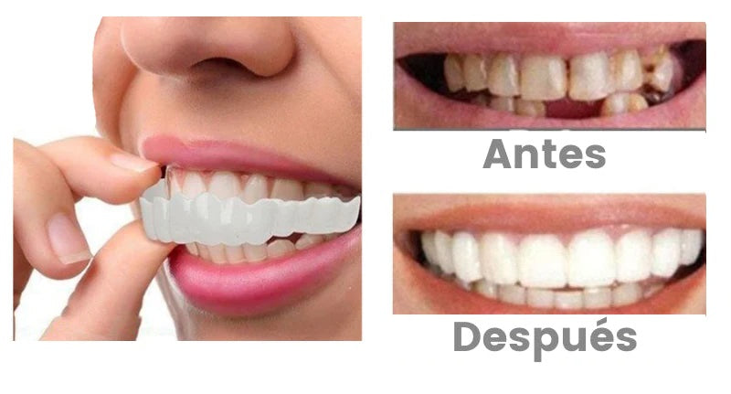 SONRISA IMPECABLE CON UNA CARILLA DENTAL DE ASPECTO NATURAL