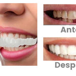 SONRISA IMPECABLE CON UNA CARILLA DENTAL DE ASPECTO NATURAL