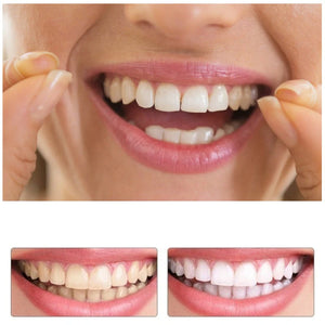 SONRISA IMPECABLE CON UNA CARILLA DENTAL DE ASPECTO NATURAL